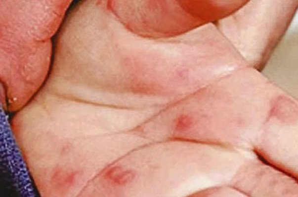 ত্বকে ফোসকা পড়লে কী করবেন