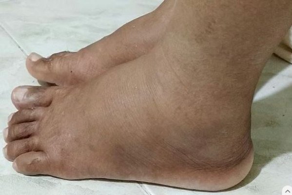 হঠাৎ পা কেন ফুলেছে?