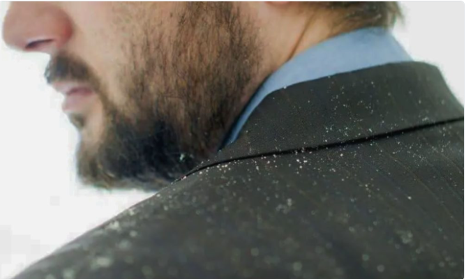 শীতে দামি শ্যাম্পু ছাড়াই দূর হবে খুশকির সমস্যা, জানুন উপায়