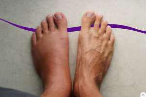 ডায়াবেটিস রোগীর পায়ের জটিল সমস্যা চারকোট আর্থ্রোপ্যাথি কেন হয়, চিকিৎসা কী