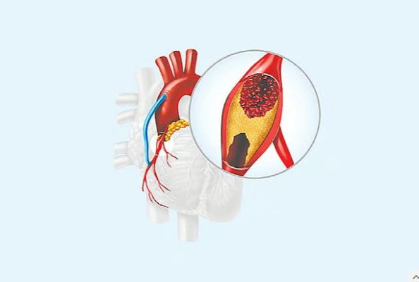 এনজিওগ্রাম ছাড়া কি হার্টের রক্তনালিতে ব্লক শনাক্ত সম্ভব