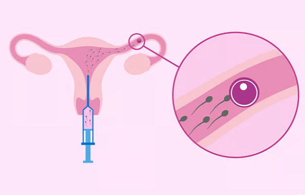 বন্ধ্যত্ব চিকিৎসায় আইইউআই, কারা এ পদ্ধতি গ্রহণ করবেন