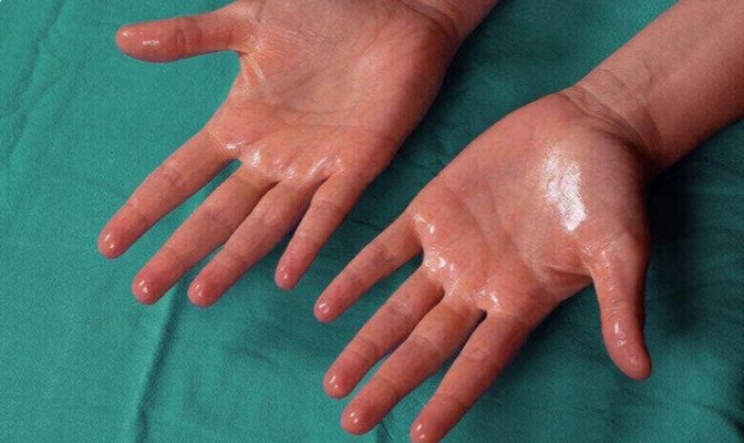 হাইপারহাইড্রোসিস : লক্ষণ ও কারণ