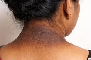 ঘাড়ের কালো দাগে যে রোগের সংকেত লুকিয়ে থাকে