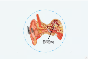টিনিটাস কী, এতে কানে কী হয়