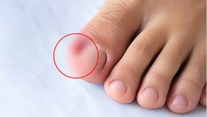 নখের কোনা দেবে যায় কেন, এমন হলে কী করবেন